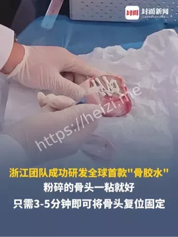 骨胶水临床应用